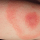 Image for article titled Did You Know Getting Bit By A Tick Could Paralyze Your Face?